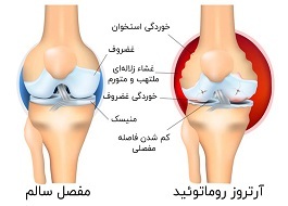 علایم و نشانههای آرتروز