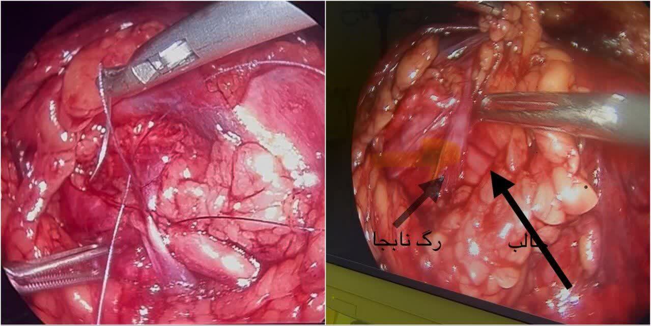 برای اولین بار تنگی مادرزادی حالب در اردبیل درمان شد برای اولین بار تنگی مادرزادی حالب در اردبیل درمان شد